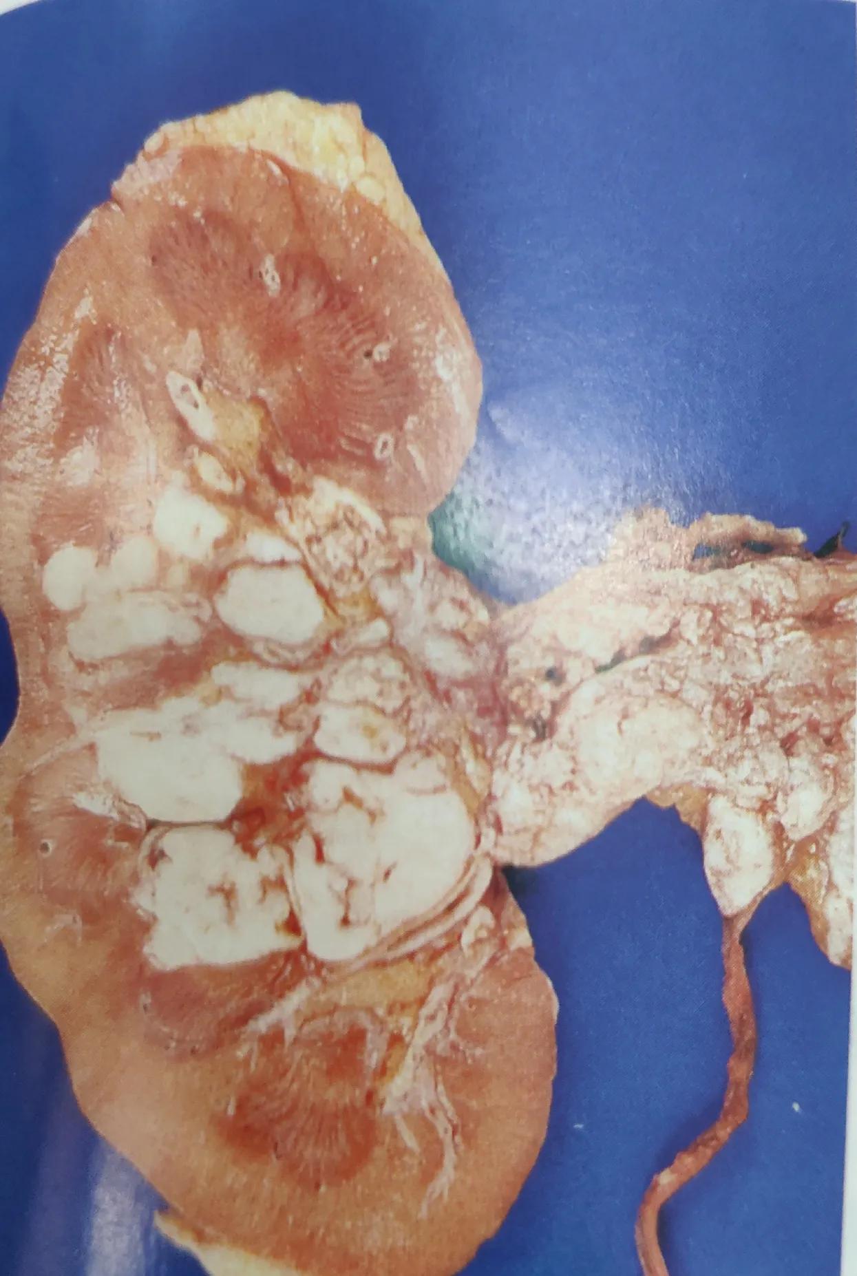 体检发现肾上有肿瘤怎么办,体检肾有个肿块是怎么回事