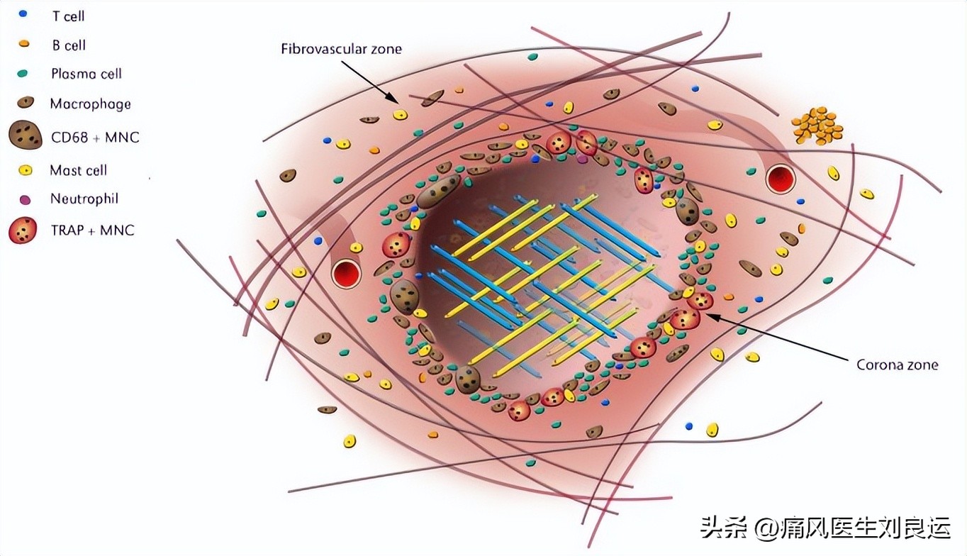 痛风男性千万别吃三种蔬菜,男子痛风长期吃止痛药