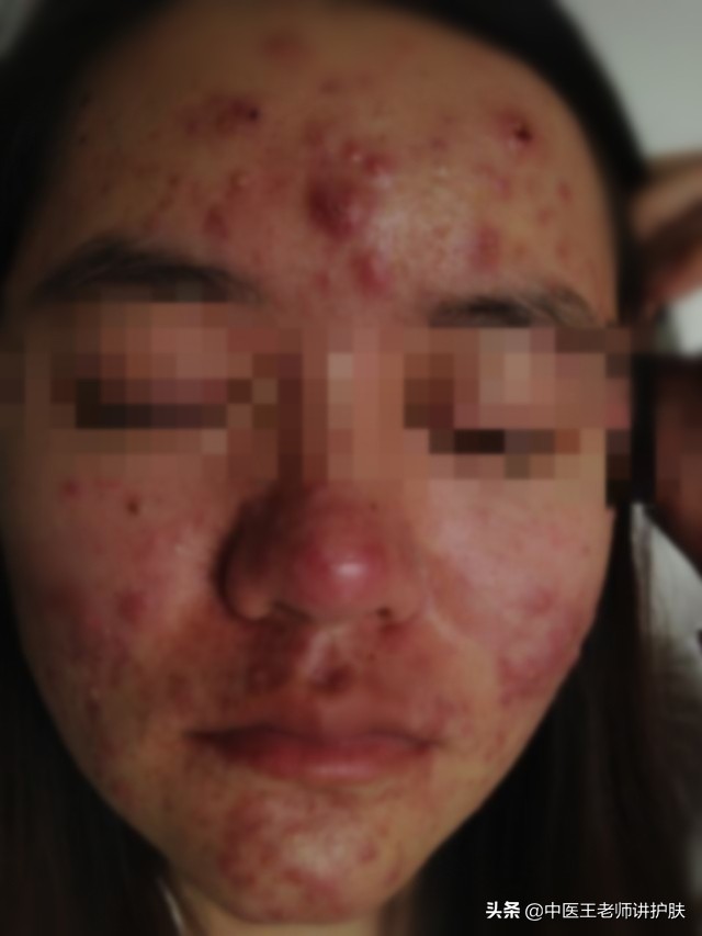 脓包型痘痘的治疗小偏方,治疗痘痘及脓疮最好的偏方