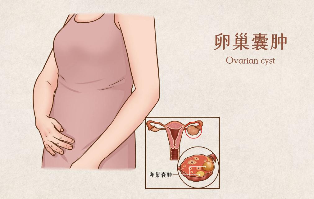 卵巢巧克力囊肿癌变的10个征兆,卵巢囊肿怎么避免