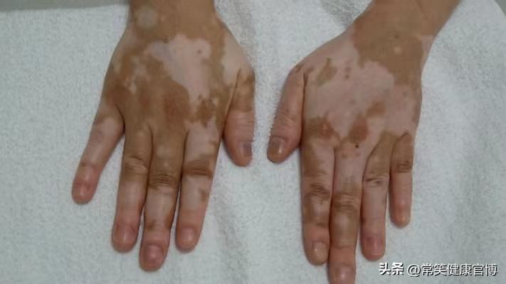 白癜风的自愈率,白癜风最新的有效治疗方法