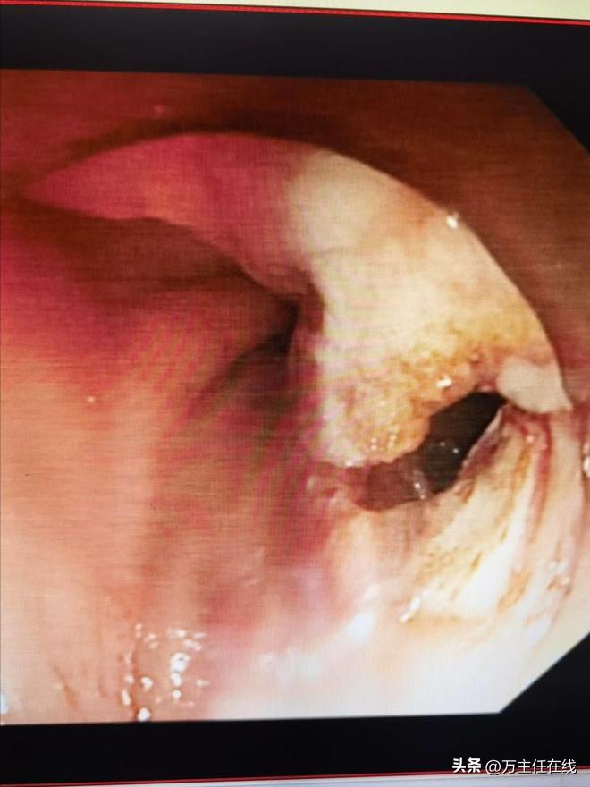 腹腔粘液癌治疗有妙招——万荣教授以内镜Notes技术成功胃减压