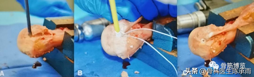 肱二头肌长头肌腱断裂超声报告,上臂肱二头肌