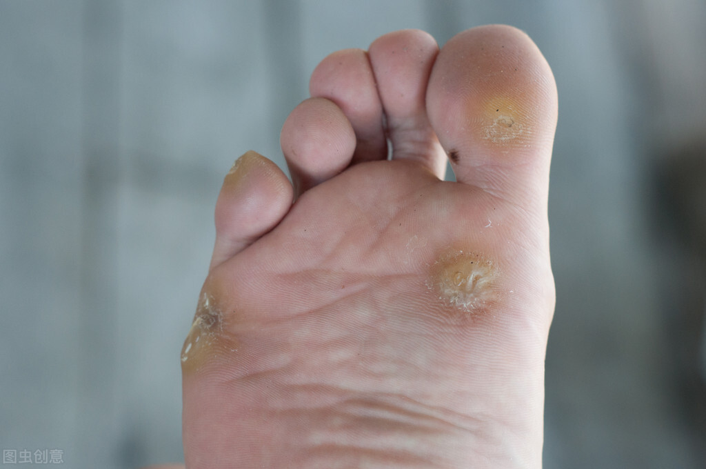 脚上有鸡眼有什么方法去除,脚上长的鸡眼怎么解决