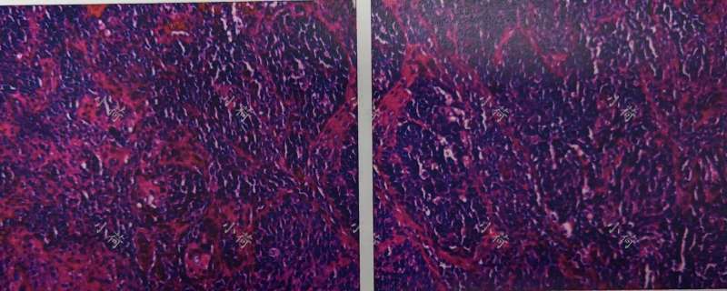 46岁得宫颈癌的人,复发宫颈癌的5年生存率