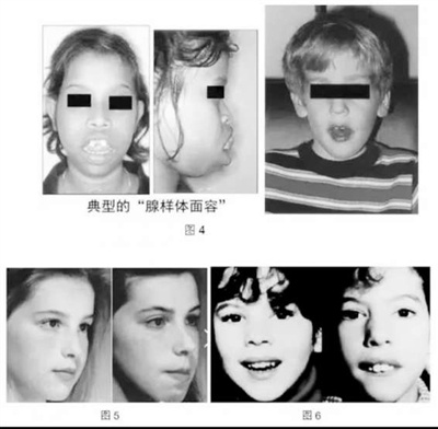 腺样体手术一天做几台,单独做腺样体手术要住院几天