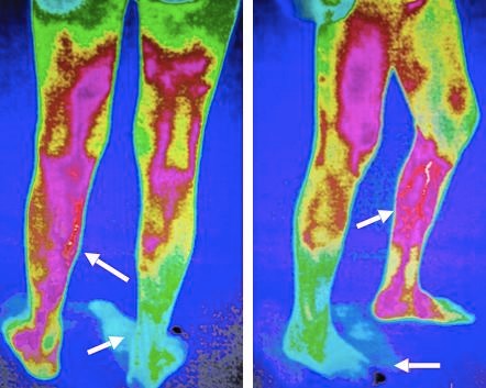 男子因修脚截肢,脚下鸡眼剪破了一直不好