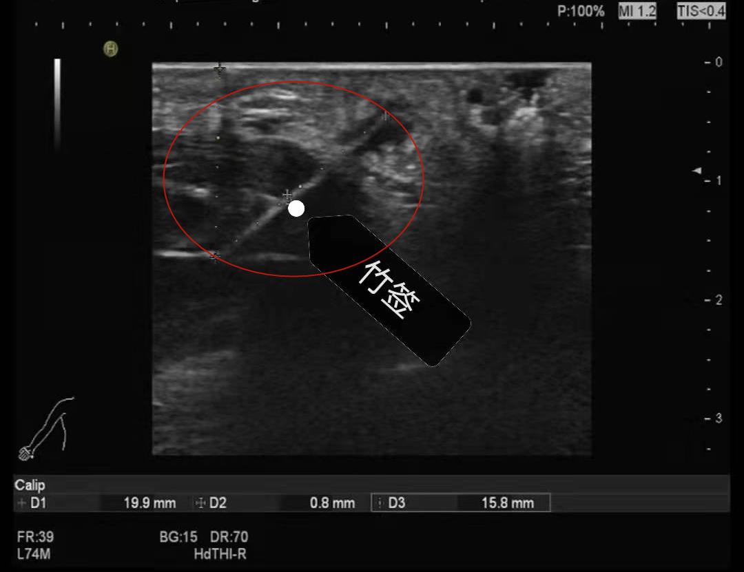 竹签扎进手指一厘米,竹签刺扎进大拇指拿不出来怎么办