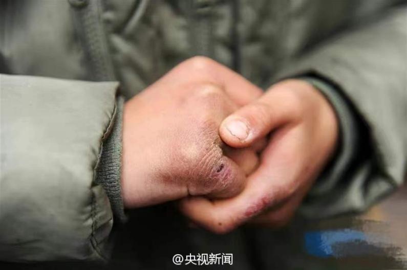 冻疮年年溃烂怎么治,冻疮又痒又肿怎么办