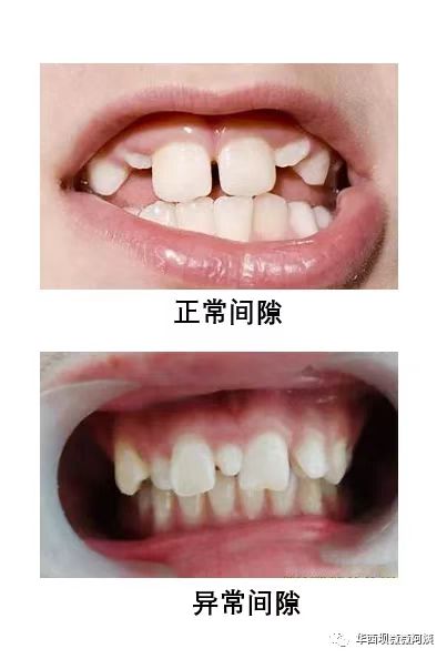 儿童早期牙齿矫正华西,华西口腔小孩矫正牙齿是什么科
