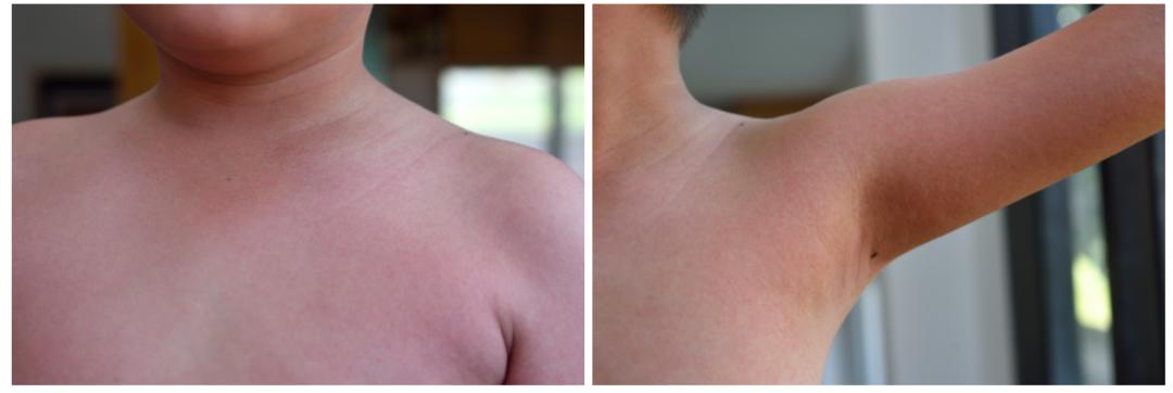 儿童生疹子哪里红点多,怎么区分孩子起的各种疹子