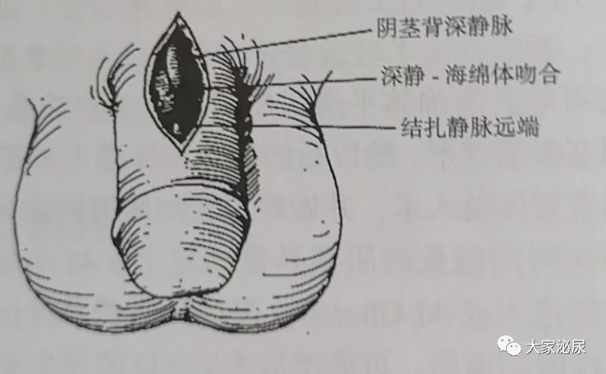 干货│缺血型阴茎异常勃起的治疗