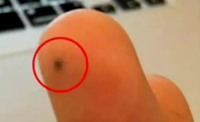 小孩把铅笔芯不小心捅进手皮里了,8岁孩子被铅笔戳到手怎么办