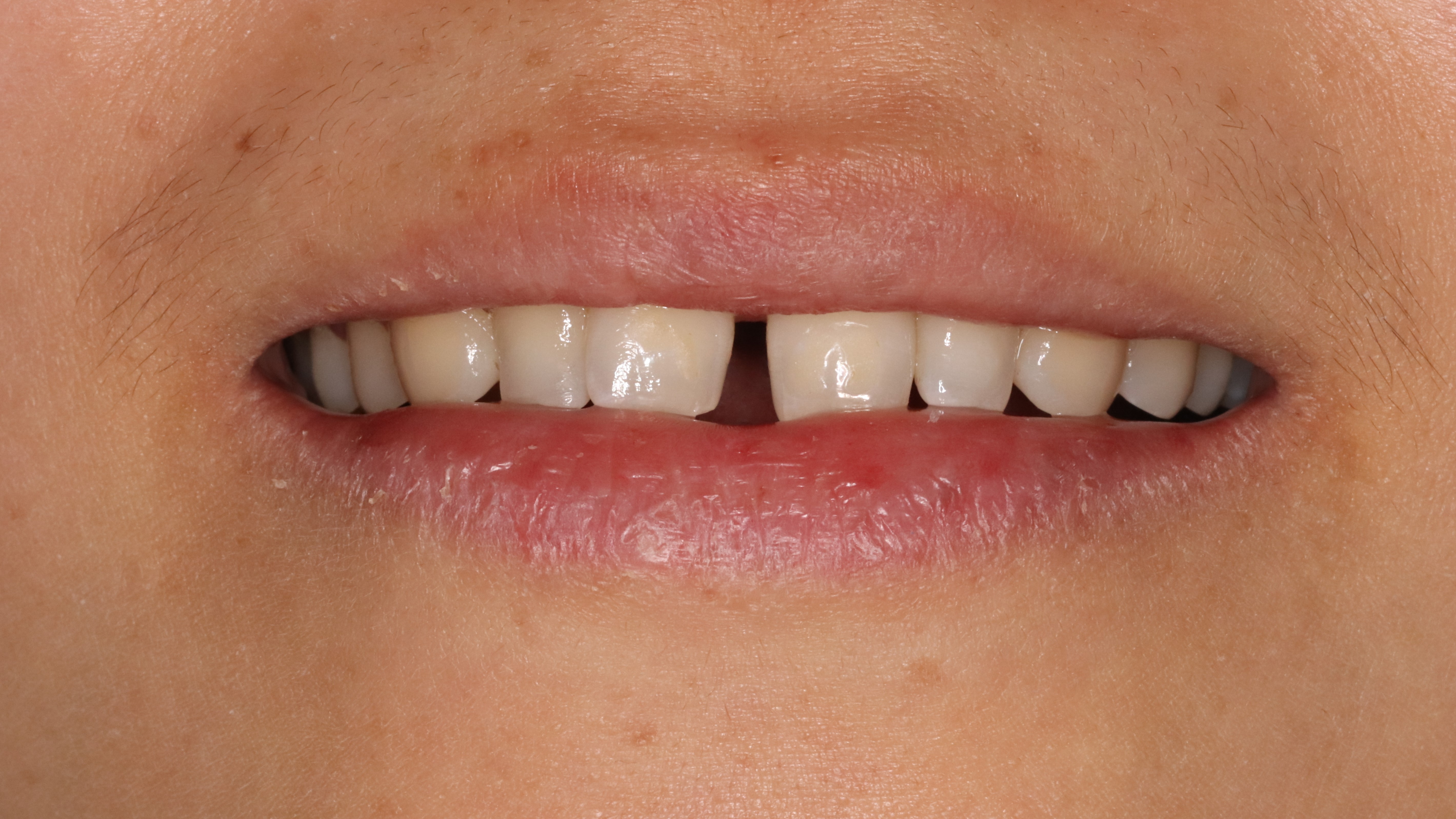 门牙缝隙修复全过程视频,树脂修复门牙缝隙的危害有哪些